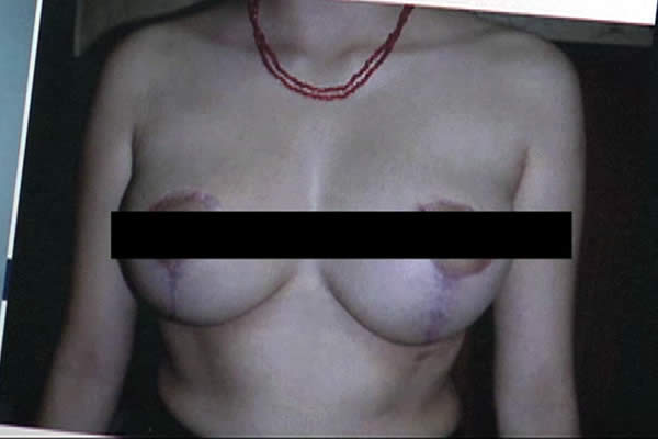 9 de cada 10 mujeres nicaragüenses tienen los senos caidos