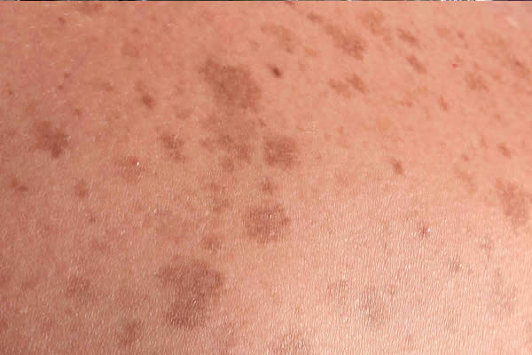 ¿Qué puede provocar manchas en la piel?