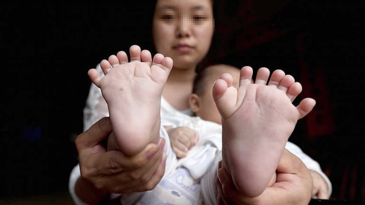 Niño chino nació con 31 dedos y sus padres ruegan por una operación