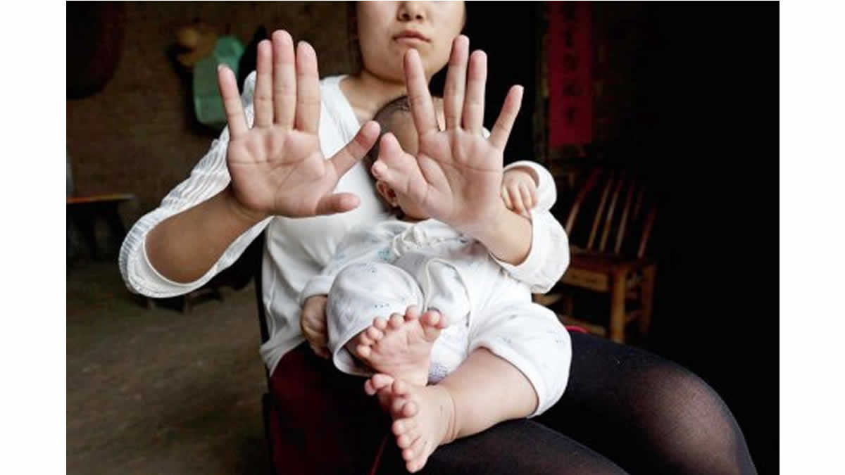 Niño chino nació con 31 dedos y sus padres ruegan por una operación