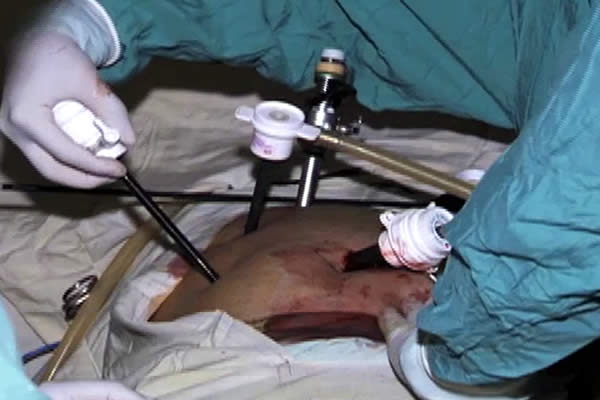 Realizan Jornada de Cirugías en el Hospital “Lenín Fonseca”