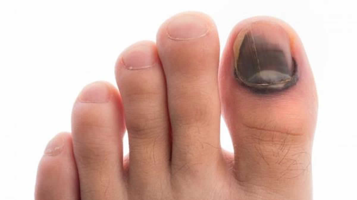 2. 10 Cute and Easy Nail Designs for Injured Toes - wide 4