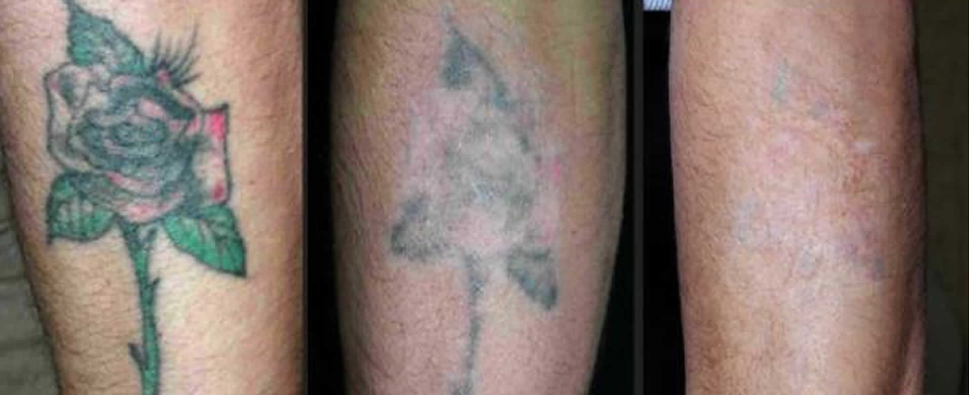 Cómo remover tatuajes de forma natural? : Viva Nicaragua Canal 13