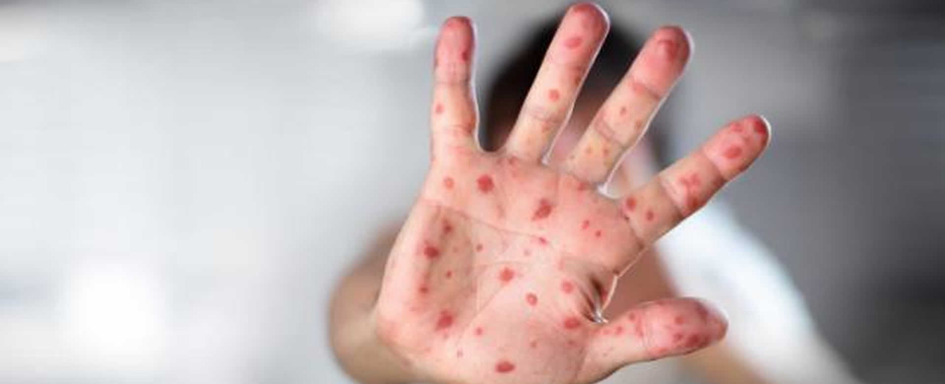 OMS: El mundo presentan aumento en indice de casos por sarampión